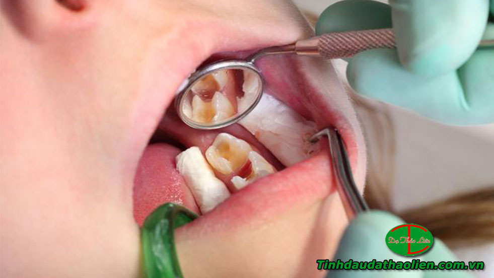 Điều trị Sâu răng ở trẻ em