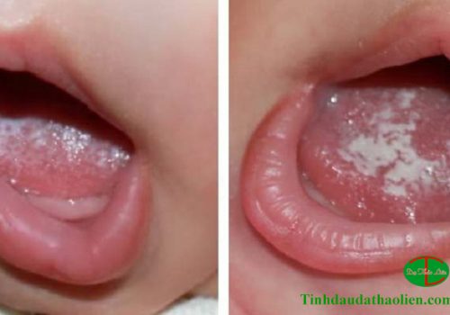 Bệnh nấm miệng