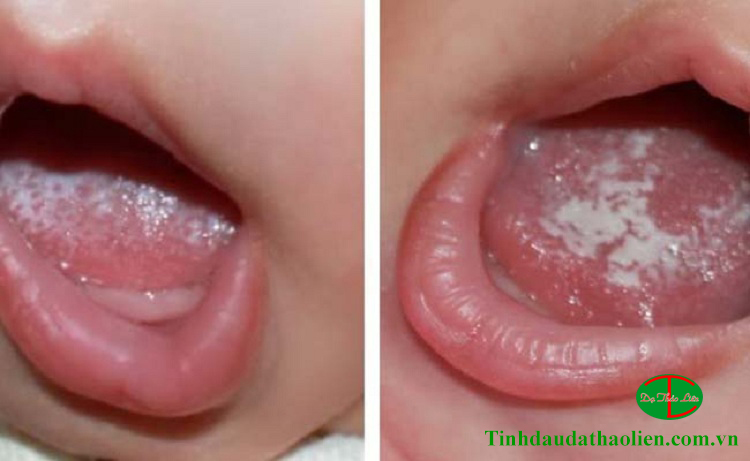 Bệnh Nấm Miệng Ở Trẻ Có Nguy Hiểm Không?