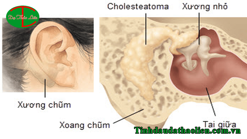 Bệnh viêm tai giữa