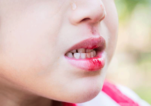 Chảy máu chân răng