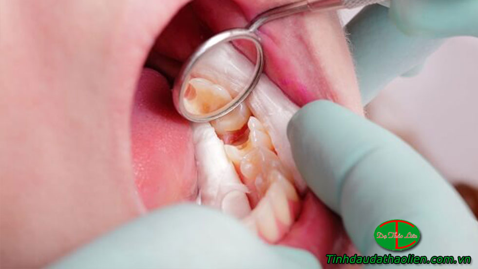 Sâu răng hôi miệng