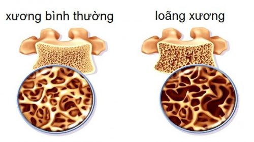 Loãng xương gây tình trạng răng bị lung lay