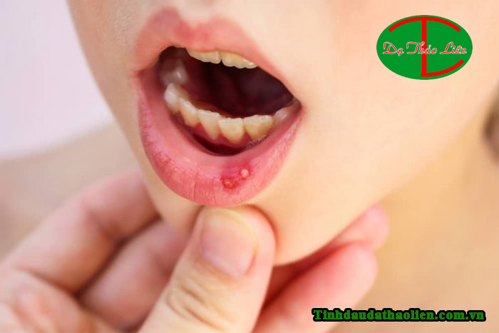 chữa nhiệt miệng tại nhà