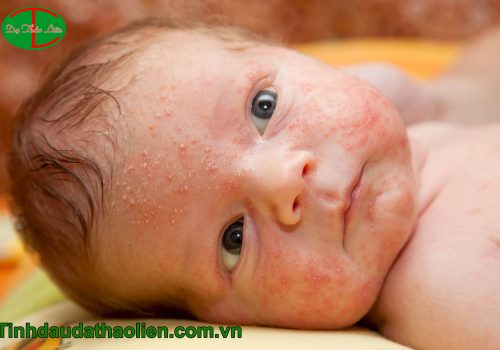 bé bị rôm sảy