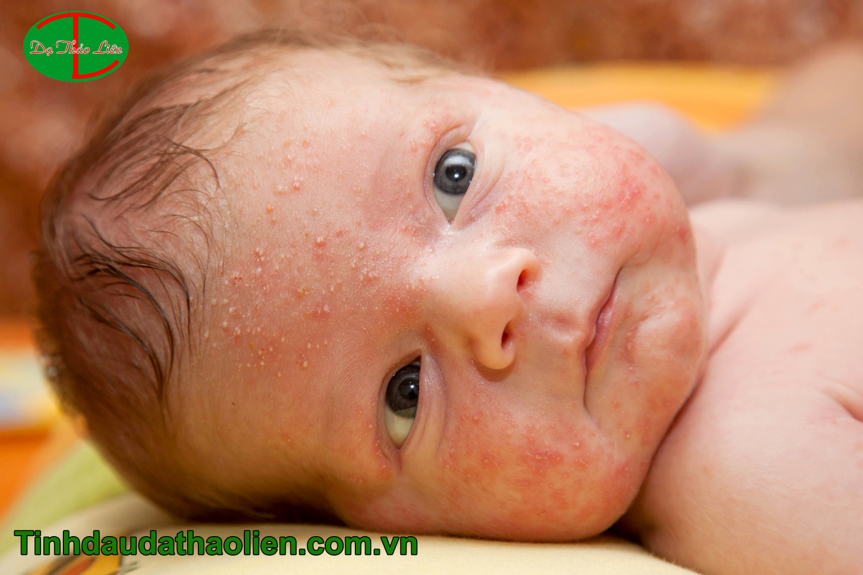 bé bị rôm sảy