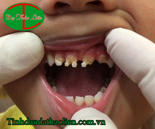 Sâu răng có nguy hiểm không