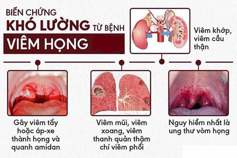 Trị viêm họng, viêm amidan bằng tinh dầu Dạ Thảo Liên