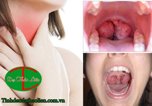 Viêm họng, viêm amidan