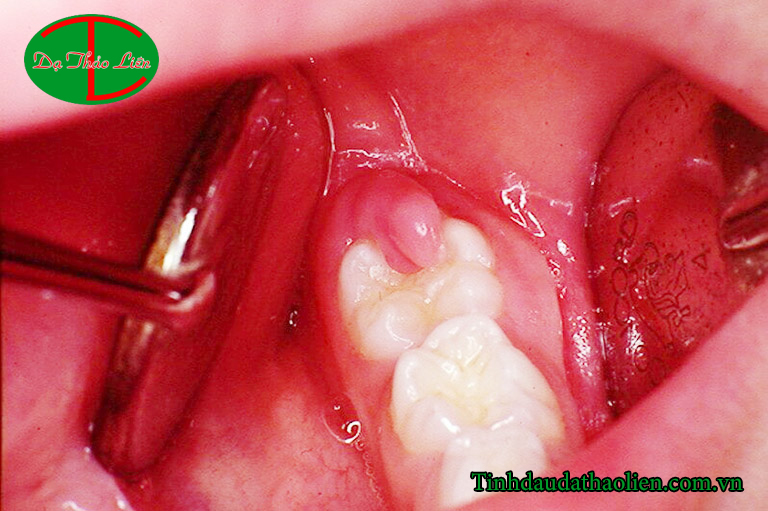 Viêm lợi có mủ 
