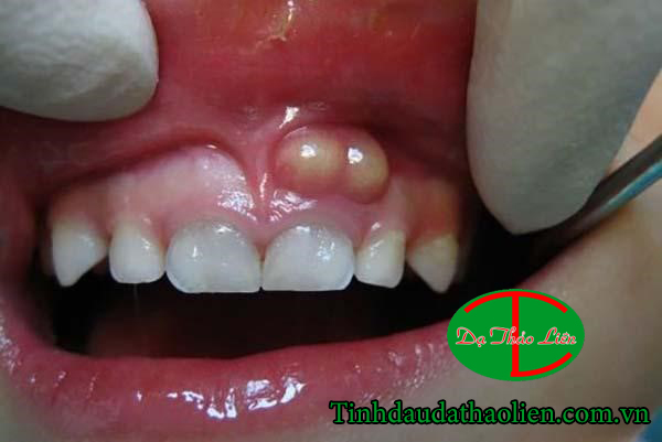 Viêm lợi có mủ 