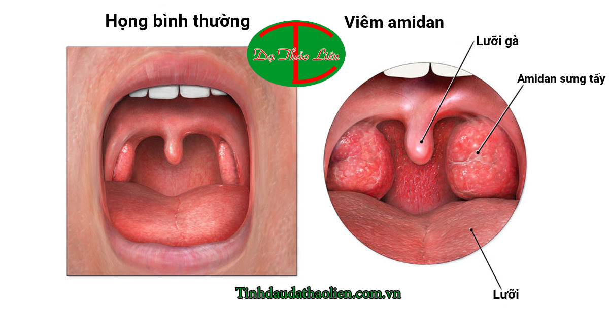 Viêm họng, viêm amidan