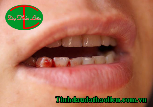 Chữa chảy máu chân răng