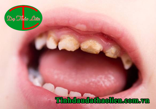 Răng bé bị mủn