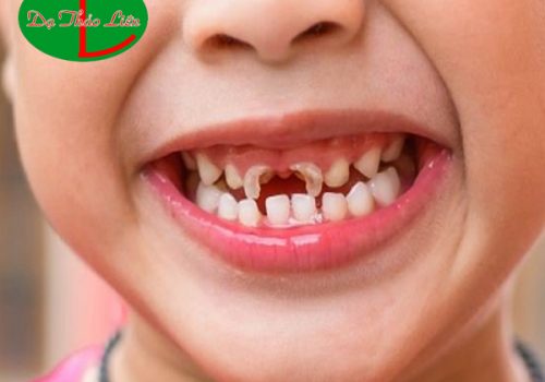 Sún răng ở trẻ