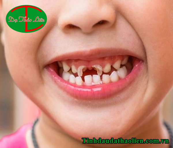Sún răng ở trẻ