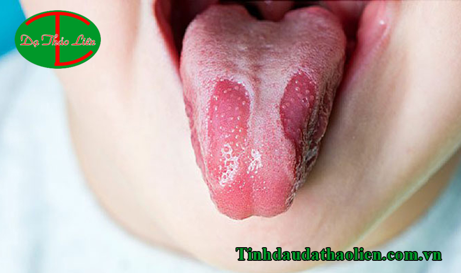 Trẻ bị nấm miệng