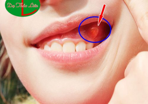 Viêm chân răng có mủ