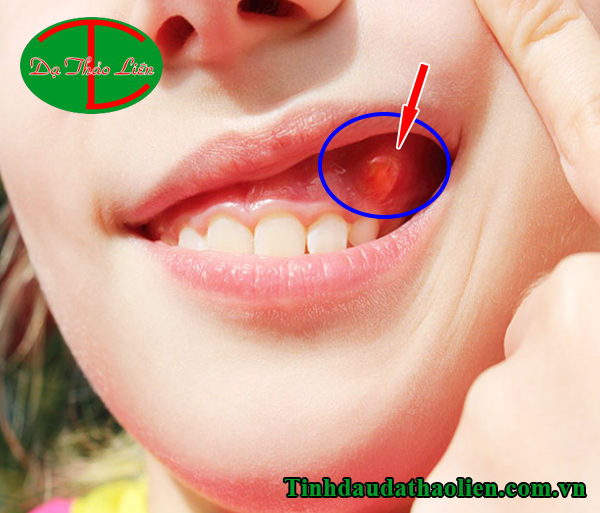 Viêm chân răng có mủ