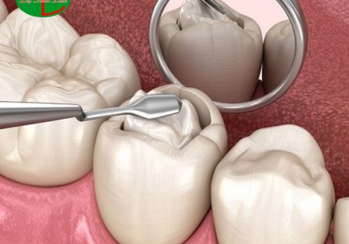 Sâu răng hàn rồi vẫn đau