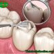 Sâu răng hàn rồi vẫn đau