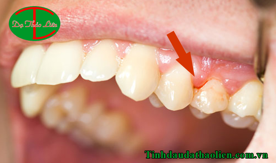 Sâu răng hàn rồi vẫn đau