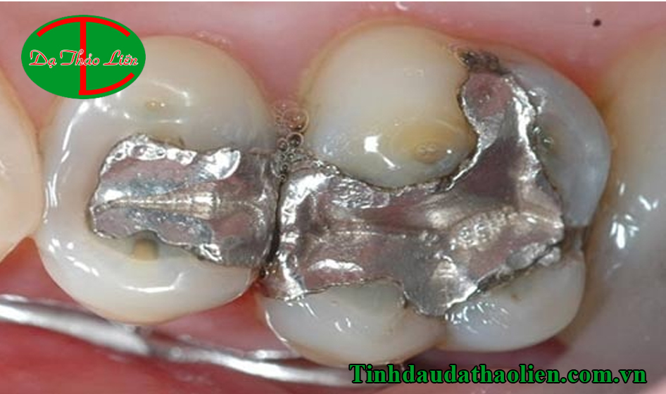 Sâu răng hàn rồi vẫn đau
