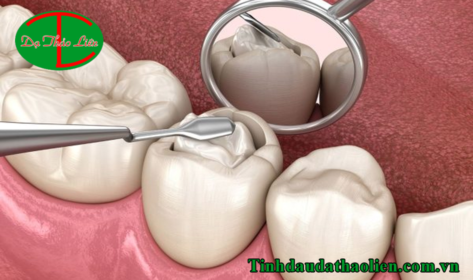 Sâu răng hàn rồi vẫn đau