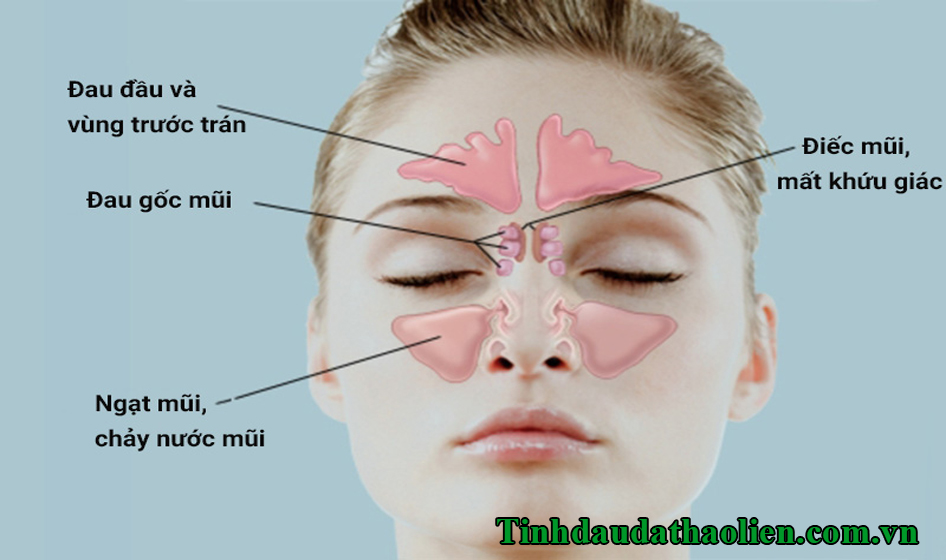 Viêm xoang có tự khỏi được không