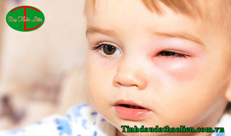 Biến chứng của viêm xoang