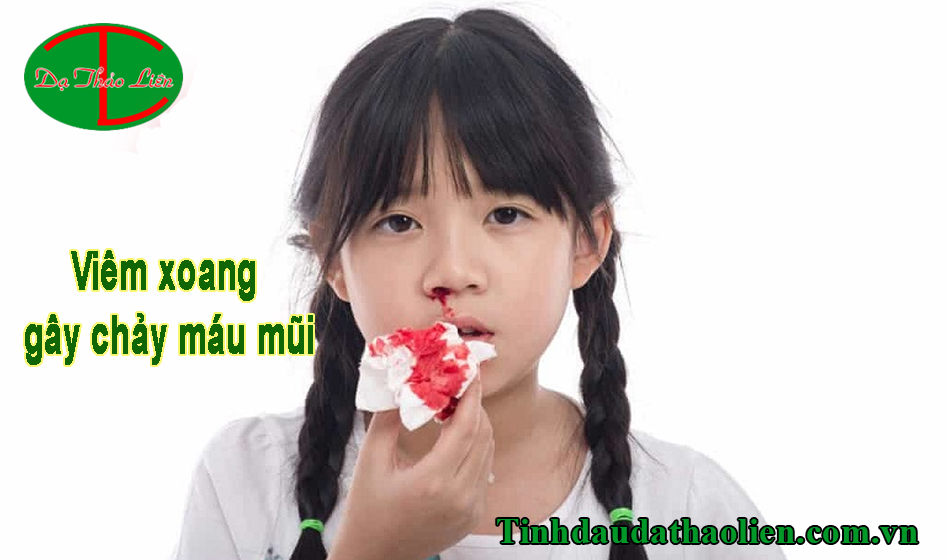 Viêm xoang chảy máu mũi