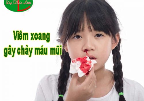 iêm xoang chảy máu mũi