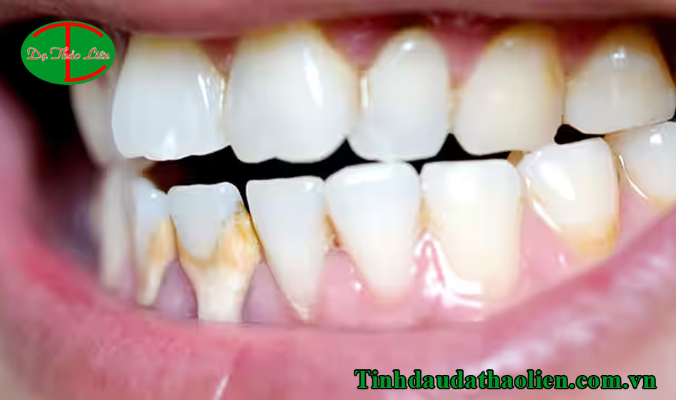 Cách trị sâu răng