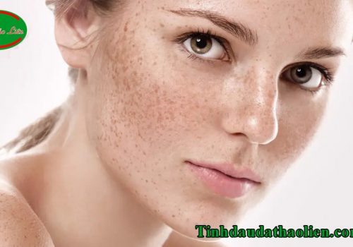 Điều trị nám tàn nhang