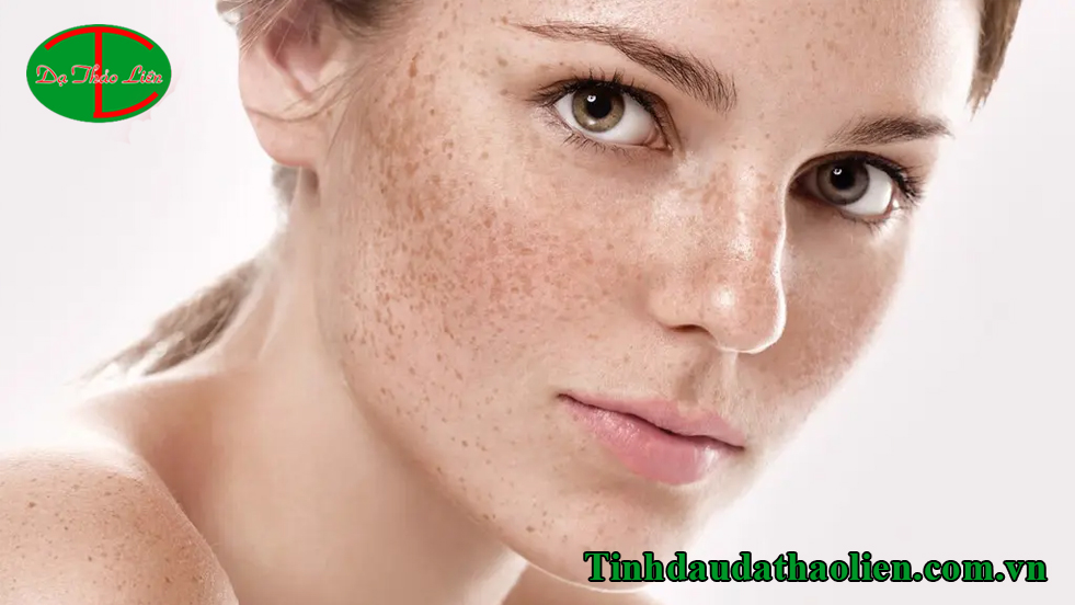 Điều trị nám tàn nhang