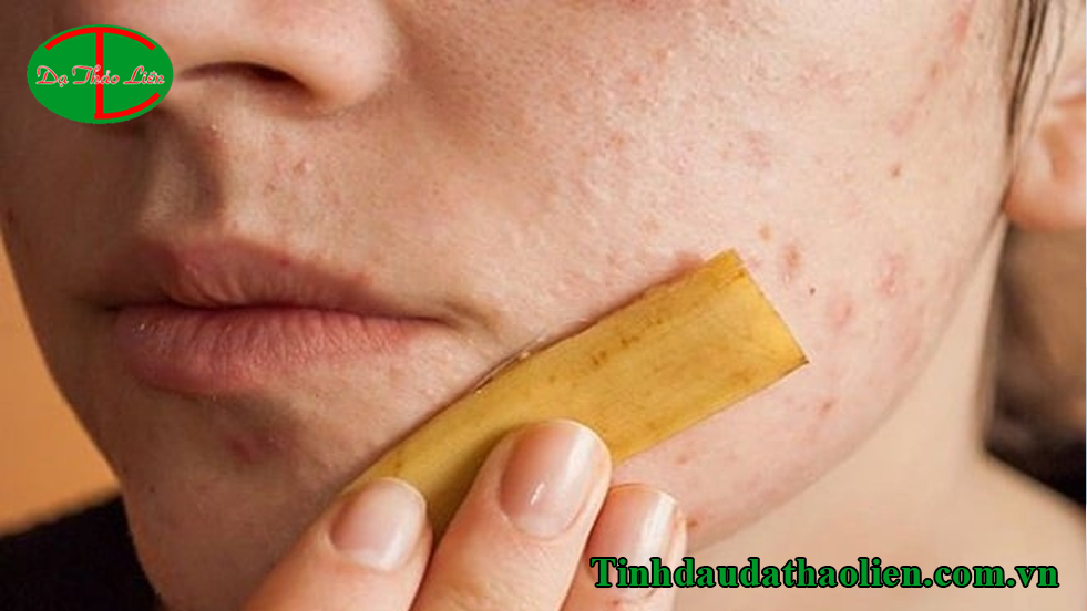 Cách trị nám tàn nhang lâu năm