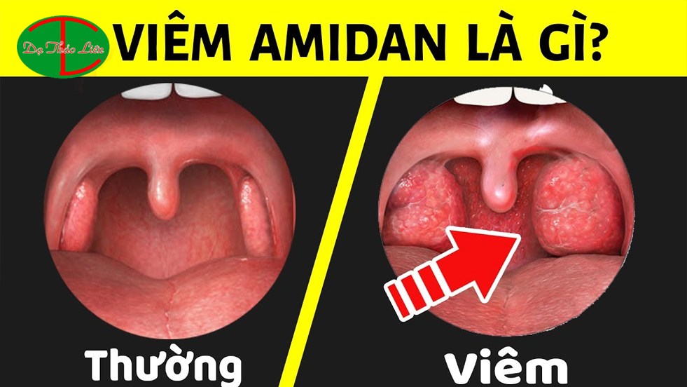 Viêm amidan