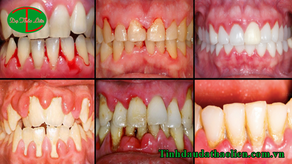 Nguyên nhân gây hôi miệng