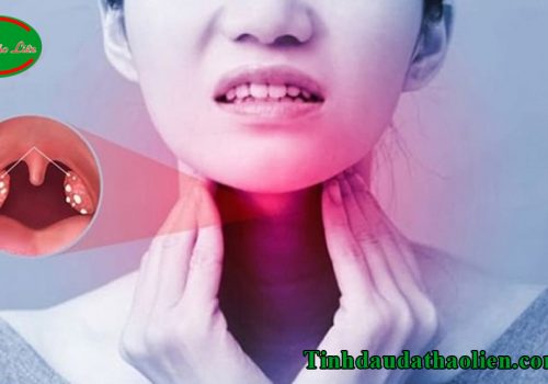 Cách điều trị viêm amidan hốc mủ