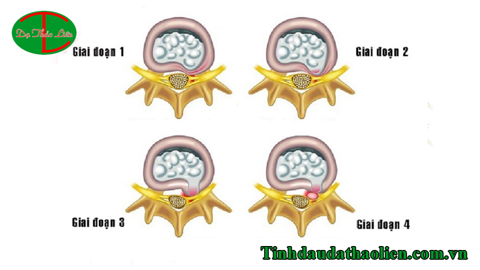 Thoát vị đĩa đệm cột sống thắt lưng