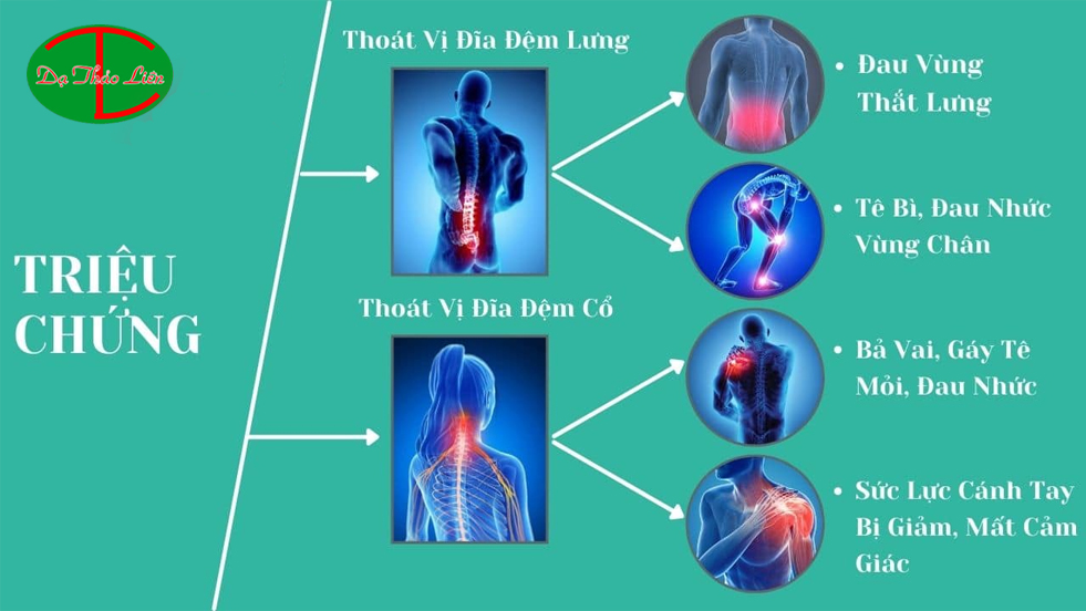 Thoát vị đĩa đệm cột sống thắt lưng