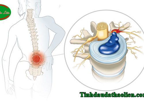Thoát vị đĩa đệm cột sống thắt lưng