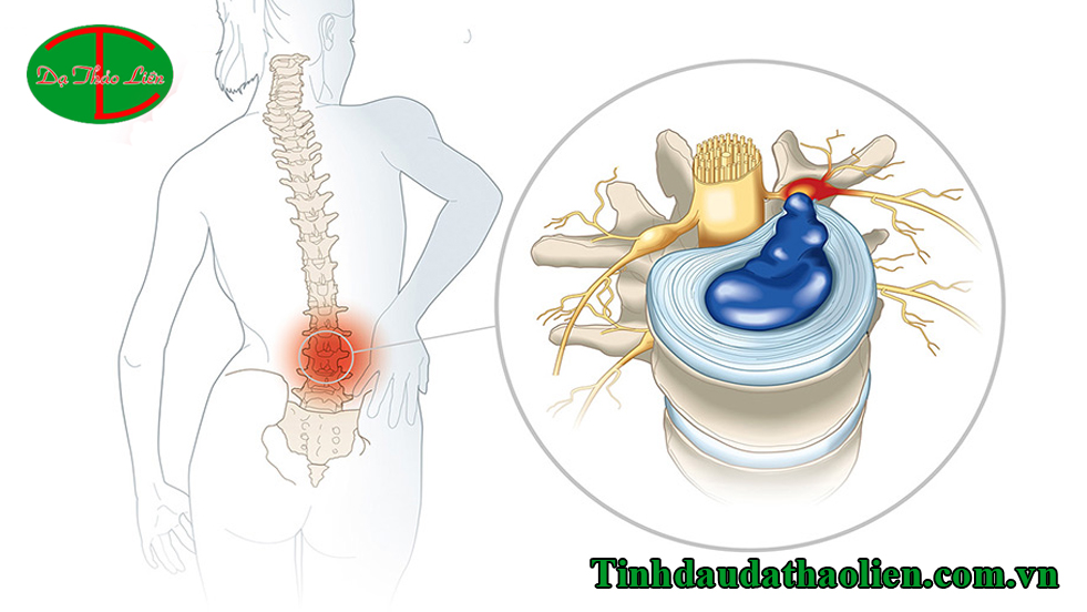 Thoát vị đĩa đệm cột sống thắt lưng