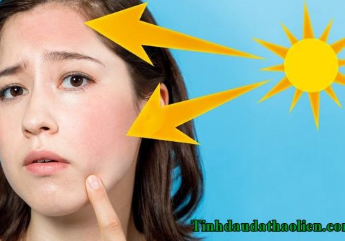 Da bị cháy nắng phải làm sao
