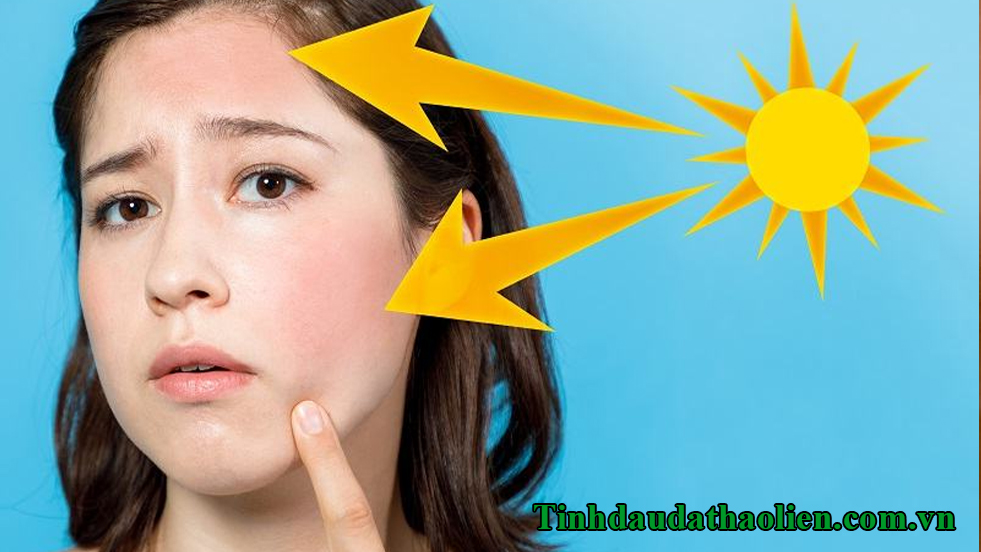 Da bị cháy nắng phải làm sao