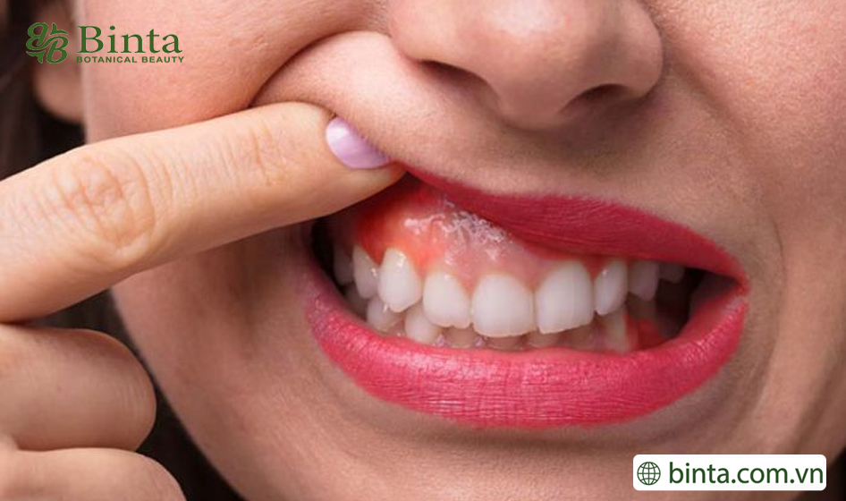 Cách trị viêm nướu